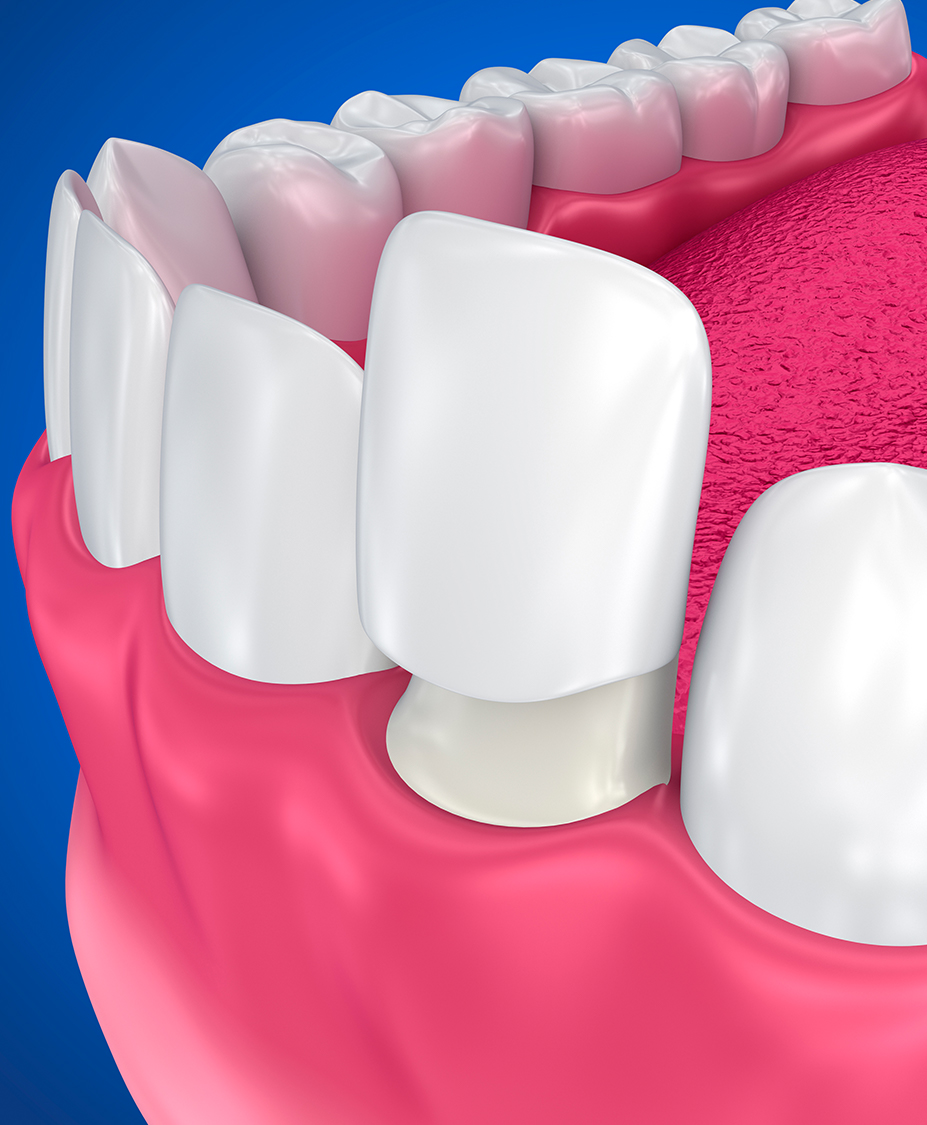 Computer generated image of how the Best Dental Veneers in Beverly Hills works. Veneer teeth over the original teeth.