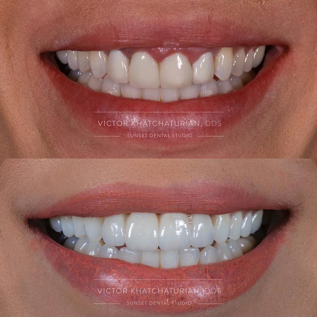 Gallery Before & After Gallery - Patient 4387400 - Image 1
