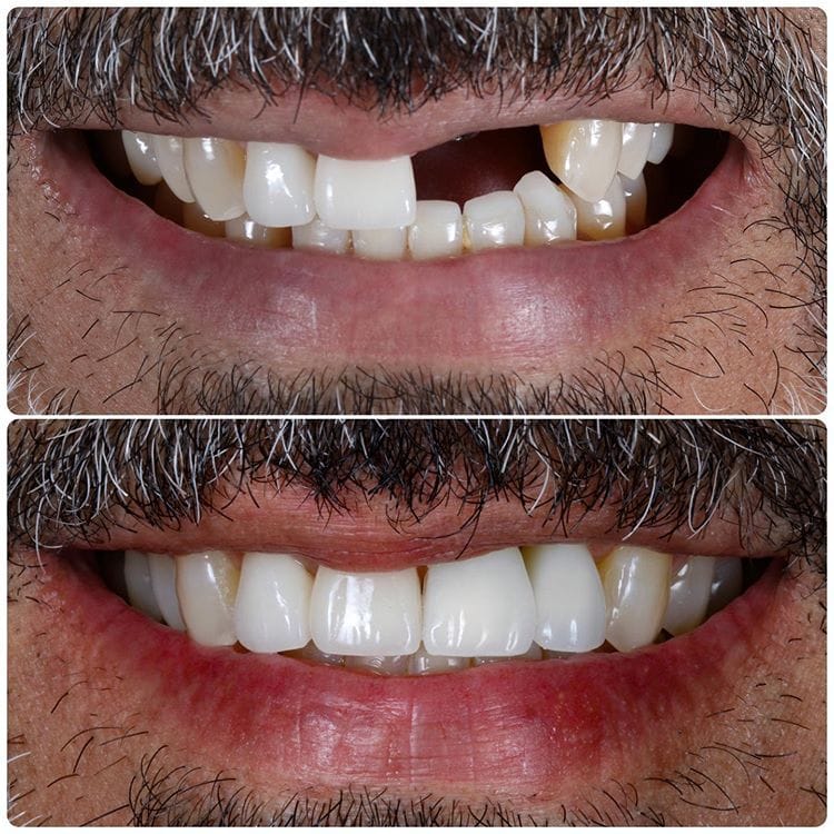 Close up before and after photos of teeth fixed with dental veneers in Beverly Hills