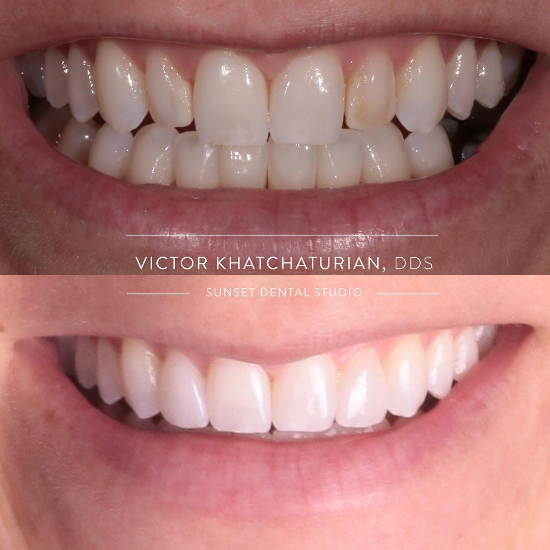 Gallery Before & After Gallery - Patient 4387420 - Image 1