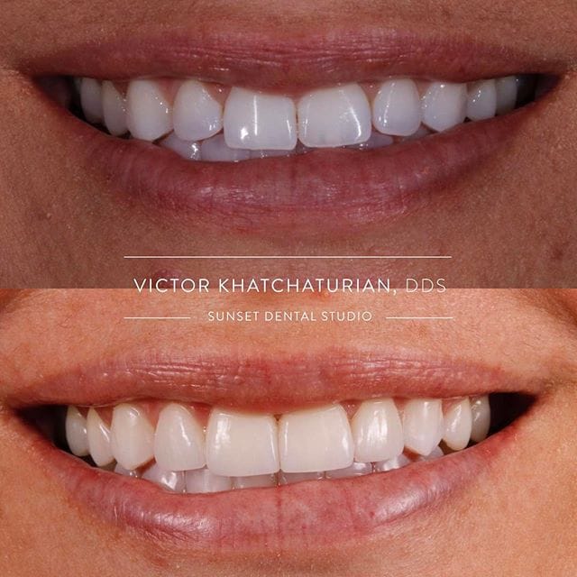 Gallery Before & After Gallery - Patient 4387428 - Image 1