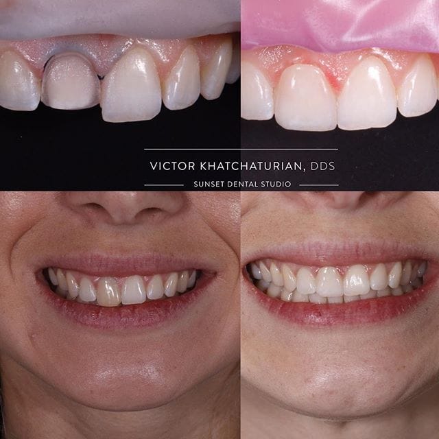 Gallery Before & After Gallery - Patient 4387435 - Image 1